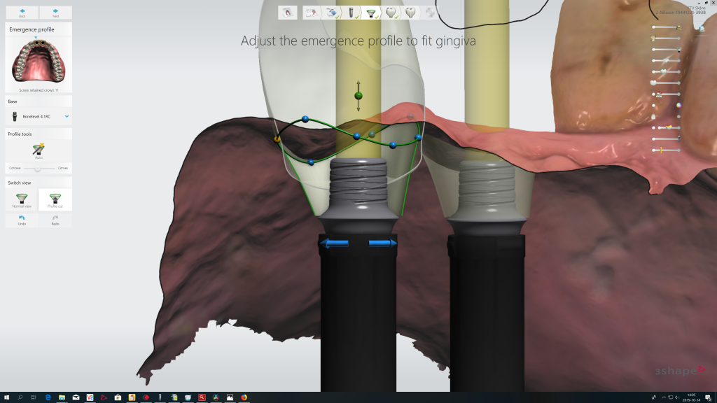 Simplified digital workflow with elos accurate hybrid base engaging available in 3shape implant studio 1024x576
