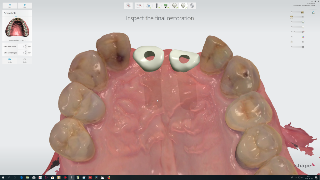 Simplified digital workflow with elos accurate hybrid base engaging available in 3shape implant studio 2 1024x576